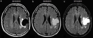 52-year-old man with resected glioblastoma. Hyperintense fluid in the resection cavity before detection of progression. Follow-up axial FLAIR sequences: (a) at 6 months after surgery, the cavity is isointense compared to ventricular CSF, (b) at 15 months, the cavity becomes hyperintense, while no findings reveal tumour progression, (c) at 16.5 months, the cavity remains hyperintense, but high-signal areas in brain parenchyma are slightly more extensive and enhance after contrast administration (not shown), establishing tumour recurrence. CSF-cerebro-spinal fluid.