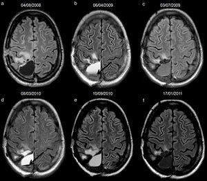 34-year-old woman with resected anaplastic astrocytoma. High-signal attributed to bleeding in the resection cavity, with resolution on subsequent studies, and without tumour progression until the last available study. Follow-up axial FLAIR sequences (a) at 4.5 months after surgery, the cavity is isointense compared to normal CSF, and a hyperintense signal in white matter is present anterior to the cavity, (b) at 12.5 months, the cavity turns hyperintense, with a fluid-fluid level in the posterior aspect of the cavity (arrow); no findings reveal tumour progression on FLAIR or other sequences (not shown), (c) at 15.5 months, the cavity remains slightly hyperintense compared to normal CSF, although it tended to normalize its signal, (d) at 23.5 months, the cavity is hyperintense with a fluid-fluid level in its posterior aspect (arrow) indicating a new episode of bleeding, (e) at 29.5 months, the cavity remains hyperintense compared to normal CSF, (f) at 33.5 months, the signal of the cavity normalizes. CSF-cerebro-spinal fluid.