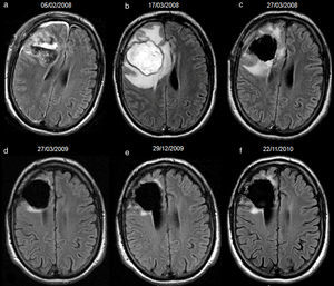 40-year-old man with resected oligodendroglioma. High-signal due to abcessified fluid in the resection cavity, with resolution on subsequent studies, and without tumour recurrence until the last study included in the analysis. Follow-up axial FLAIR sequences (a) at 4 days after surgery, the signal of the cavity is heterogeneous due to debris and haemorrhage, (b) at 1.5 months, the cavity is hyperintense compared to ventricular CSF; the association with prominent oedema, ring-enhancement, restricted diffusion and low rCBV (not shown) indicates an abscess in the cavity; no findings reveal tumour recurrence on FLAIR or other sequences (not shown), (c) after draining the abscess and 10 days later, the signal of the cavity turns isointense compared to ventricular CSF, (d–f) subsequent studies at 14, 23 and 34 months, the cavity remains isointense. CSF-cerebro-spinal fluid, rCBV-relative cerebral blood volume.