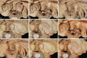 A-E)Disección sistemática de la superficie inferior o suboccipital del cerebelo hasta exponer la cavidad del IV ventrículo y las relaciones con los pedúnculos cerebelosos y núcleo dentado (nd). F-I corresponden a las imágenes B-E en 3D, respectivamente. ac: amígdala cerebelosa; br: bulbo raquídeo; flc: flóculo; ncd: núcleo coclear dorsal; nd: núcleo dentado; pci: pedúnculo cerebeloso inferior; pcm: pedúnculo cerebeloso medio; pco: plexo coroideo; pcs: pedúnculo cerebeloso superior; rl: receso lateral; tco: tela coroidea; td: tubérculo dentado; uv: úvula; vmi: velo medular inferior; IX-X: nervios glosofaríngeo y vago; IV-v: IV ventrículo.