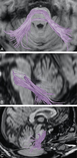 Demostración de los pedúnculos cerebelosos medios mediante imágenes de DTT en distintos planos de RM cerebral.