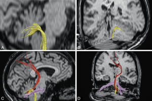 Demostración de los pedúnculos cerebelosos inferiores (A y B) y conjuntamente de los 3 pedúnculos cerebelosos (C y D) mediante imágenes de DTT en distintos planos de RM cerebral.