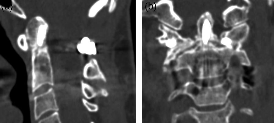 Transcervical approach with endoscopic assistance for surgical ...