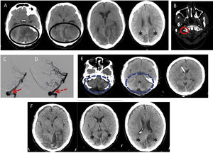 Infratentorial massive stroke. Left VA partial obstruction. (A) CT: Massive ischemic stroke in left cerebellar hemisphere and edema (Black Circle). (B) CTA: Hypoplasia of the right VA (red circle). (C) Angiography: thrombus at the level of left VA-V2 segment (Red Arrow) evidencing low flow in posterior circulation). (D) Flow restored after thrombectomy (Red Dotted Arrow). (E) CT: Suboccipital craniectomy and ventricular drain. A notably radiological improvement of the posterior fossa stroke (Blue Dotted Circle). (F) CT: The resolution of hydrocephalus and improvement of the bilateral occipital strokes. * Bilateral stroke in occipital lobes, CTA: CT-Angio, CT: computerized tomography, VA: vertebral artery.
