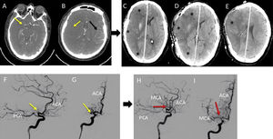 Malignant stroke. Right ACM obstruction. (A, B) CTA: Stop in M1 and absence of flow in the right insular region of the r-ACM (Yellow Arrow); contralateral normal flow (Black Arrow). (C) A malignant infarction (*) of the r-ACM that exerts midline deviation. (D, E) Right decompressive hemicraniectomy with an improvement of midline displacement. (F, G) Angiography: The absence of flow in the r-ACM. Thrombus in segment M1 (yellow Arrow). (H, I) Flow restored in r-ACM after thrombectomy (Red Arrow). CTA: CT-Angio, CT: Computerized Tomography, r-MCA: Right Middle Cerebral Artery, ACA (Anterior Cerebral artery), PCA (Posterior Cerebral Artery).
