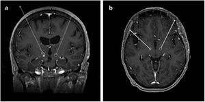 Example MRI showing the trajectories of the implanted electrodes in the coronal (a) and axial (b) planes. The electrode artefacts visible in the post-operative CT scan were used to determine the entry point and the distal tip.