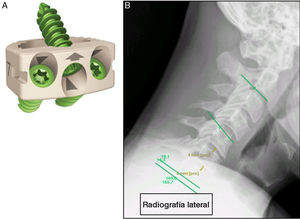 Dispositivo y esquema de medición. (A) Representación esquemática de la jaula intercorporal de PEEK-titanio anclada de perfil cero con tornillos integrados. (B) Esquema de medición radiográfica lateral que muestra el ángulo de Cobb segmentario (verde) medido entre la placa terminal inferior de la vértebra superior y la placa terminal superior de la vértebra inferior; el ángulo de Cobb global en C2-C7 y la altura de los discos C5-C7.