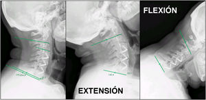 Caso 37: radiografías dinámicas de flexión/extensión. (A) Vista lateral en flexión en el seguimiento a largo plazo que no muestra movimiento segmentario en los niveles operados. (B) Vista lateral en extensión en el seguimiento a largo plazo que confirma la ausencia de inestabilidad y demuestra una construcción intercorporal estable.