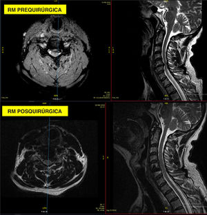 Caso 3: RM cervical pre- y postoperatoria. (A) Imágenes preoperatorias axiales y sagitales ponderadas en T2 que demuestran la estenosis en el nivel operado. (B) Imágenes postoperatorias axiales y sagitales ponderadas en T2 que muestran una descompresión adecuada con un artefacto de susceptibilidad mínimo de la jaula de PEEK-titanio anclada.