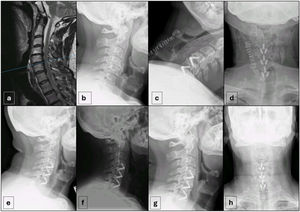 Radiografías representativas de la cohorte (caso 37). (a) RM sagital ponderada en T2 preoperatoria que demuestra estenosis cervical. (b) Radiografía lateral preoperatoria que muestra estrechamiento del espacio discal. (c y d) Radiografías postoperatorias inmediatas (vistas lateral y anteroposterior) tras la DFCA con una jaula de PEEK-titanio anclada. (e-h) Radiografías de seguimiento a largo plazo, incluidas vistas lateral, anteroposterior y de flexión/extensión dinámica, que demuestran el mantenimiento de la alineación, la fijación estable y la ausencia de movimiento segmentario.
