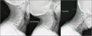 Caso 39: seudoartrosis al año (Bridwell III). (A) Radiografía de extensión que demuestra una línea radiolúcida persistente en el nivel operado. (B) Radiografía en extensión que muestra movimiento segmentario compatible con seudoartrosis. (C) Radiografía en flexión que confirma la ausencia de puente óseo. El paciente era asintomático y alcanzó la fusión radiográfica completa a los 2años de seguimiento.