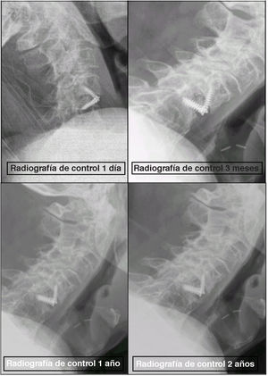Caso 35: hundimiento de la jaula con progresión benigna a fusión sólida. (A) Radiografía lateral al primer día postoperatorio. (B) Radiografía a los 3 meses que muestra hundimiento en la placa terminal superior. (C) Radiografía al año que muestra una consolidación progresiva. (D) Radiografía a los 2años que confirma una fusión sólida y el mantenimiento de la alineación sin necesidad de cirugía de revisión.