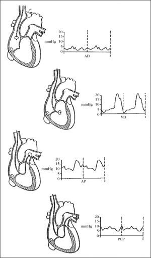 Modificación de la onda que aparece en el monitor al atravesar las diferentes cavidades. AD: aurícula derecha; AP: arteria pulmonar; PCP: presión de enclavamiento capilar pulmonar; VD: ventrículo derecho.