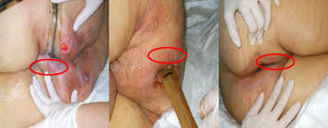Lesiones por decúbito asociadas a dispositivo para control de eliminación fecal.