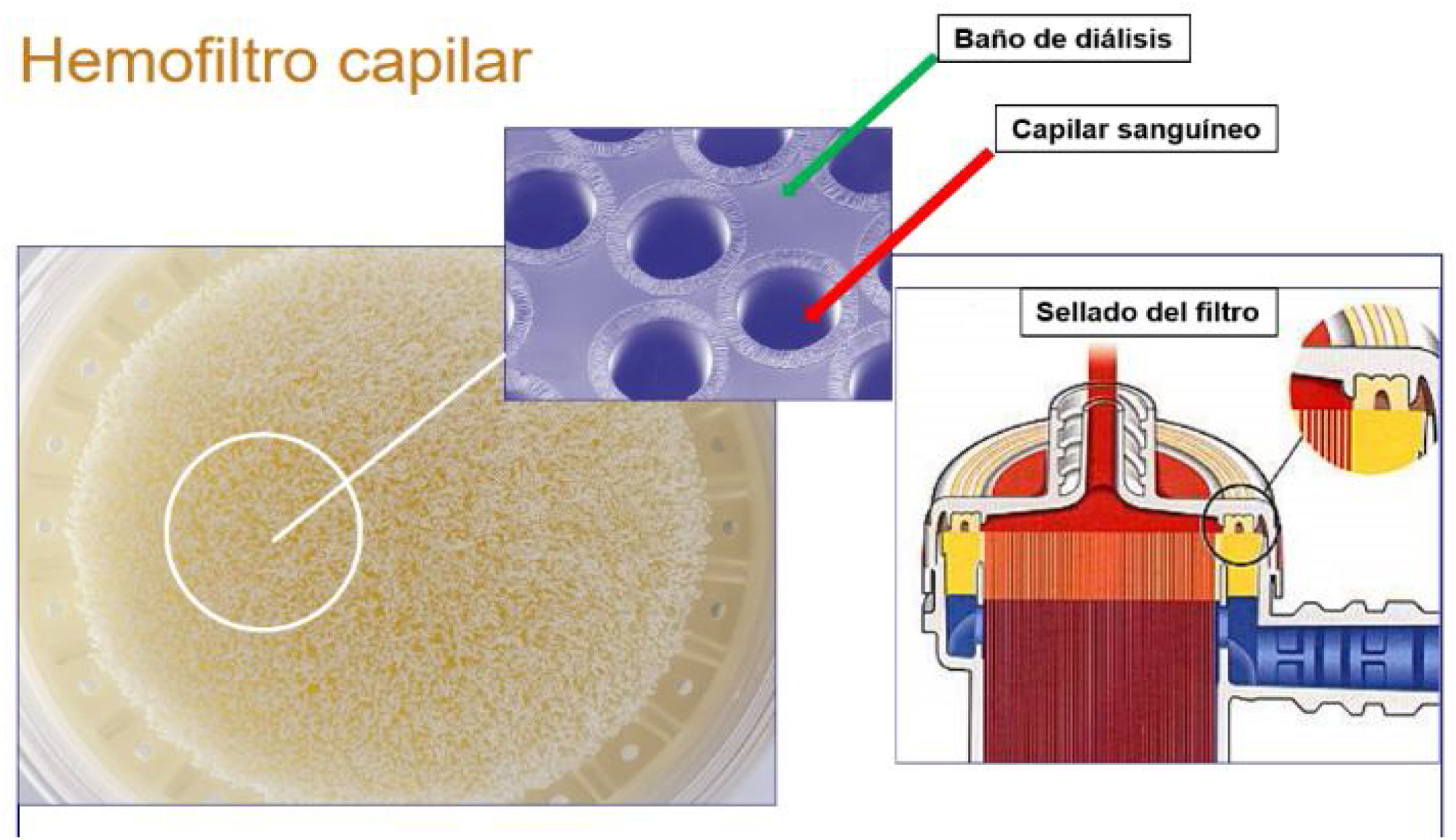 Membranas En Terapias Depurativas Continuas Enfermer a Intensiva membranas-en-terapias-depurativas-continuas-enfermer-a-intensiva