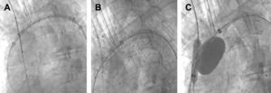A Colocación de la endoprótesis aórtica y el stent de la rama. B Postexpansión. C Postexpansión con balón de angioplastia.