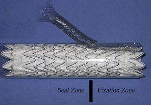Modelo de stent en doble cañón mostrando las zonas de fijación y sellado.
