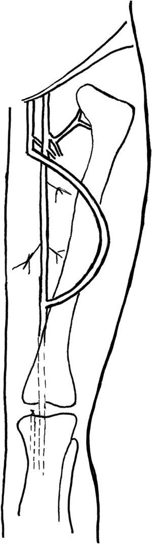 Transposición de vena femoral (VF) en muslo izquierdo. Se labra un túnel con la VF en orientación anterior a la arteria femoral superficial. La disección se extiende desde la confluencia de la vena profunda a la confluencia de la vena poplítea.