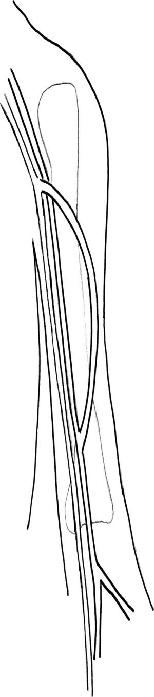 Translocación de la vena femoral (VF) a la extremidad superior izquierda. La VF se transloca a la extremidad superior izquierda con una anastomosis proximal a la vena axilar y una anastomosis distal a la arteria humeral.