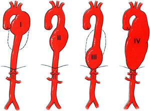 Sistema de clasificación de los aneurismas de la aorta torácica descendente13.