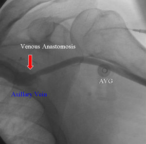 Fistulografía que demuestra la anastomosis venosa. AVG: injerto arteriovenoso.