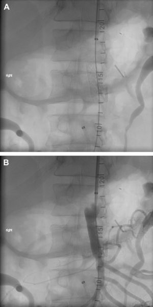 A.Stent expandible desplegado, montado sobre balón. B. Angiografía al completar el procedimiento que muestra la resolución de la fístula arteriovenosa de la arteria mesentérica superior tras despliegue de la endoprótesis.