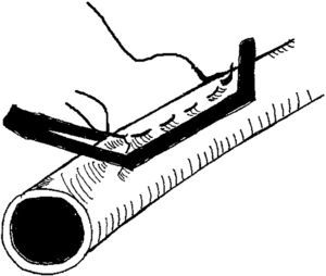 Diagrama de la plicatura de la vena nativa con una sutura de colchonero horizontal usando un clampaje de Satinsky como guía del grado de plicatura.