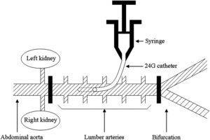 Diagrama del método de producción de isquemia de la médula espinal e inyección de edavarona en el presente estudio. La aorta abdominal se interrumpió con clampajes vasculares por debajo de la arteria renal y por encima de la bifurcación. Inmediatamente después del clampaje, se inyectó el fármaco en el segmento aórtico clampado a través de un catéter de calibre 24 durante un minuto. Left kidney = Riñón izquierdo. Syringe = Jeringa. 24G catéter = Catéter de calibre 24. Right kidney = Riñón derecho. Abdominal aorta = Aorta abdominal. Lumber arteries = Arterias lumbares. Bifurcation = Bifurcación.