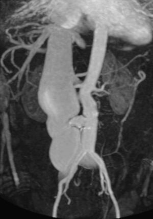 Angiografía por resonancia magnética del abdomen que muestra una fístula aortocava entre la aorta infrarrenal y la vena cava inferior.