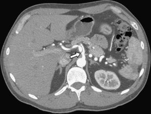 Paciente 1: TC de seguimiento efectuada 3 meses más tarde que demuestra la estabilidad de la disección. La dilatación aneurismática no se ha modificado y el trombo mural se ha resuelto. En el bazo se demostraron cambios atróficos después del infarto.