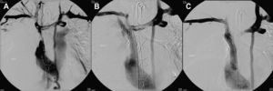 A Flebograma mostrando la VCS ocluida antes de la intervención endovascular. B Contraste que muestra la extravasación tras el despliegue inicial del stent recubierto y la angioplastia con balón de la estenosis residual. C Angiograma tras finalizar el despliegue del stent recubierto.