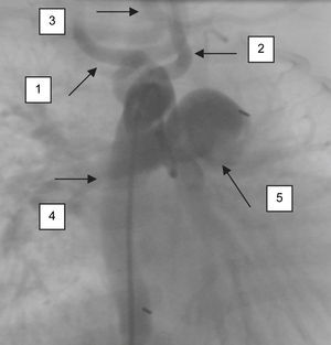 Visión anteroposterior del cayado aórtico después de la inyección de contraste en la aorta ascendente. 1, Arteria carótida derecha; 2, arteria carótida izquierda; 3, tronco subclavio común; 4, aorta descendente; 5, arteria pulmonar principal.