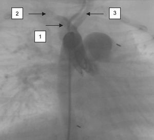 Visión anteroposterior de las arterias vertebrales después de la inyección de contraste en la aorta ascendente. 1, Tronco vertebral común; 2, arteria vertebral derecha; 3, arteria vertebral izquierda.