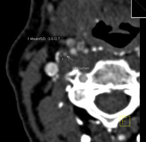 Tomografía computarizada multidetector. Placa con la menor densidad tisular medida de –3 UH. F: posición del paciente en relación con la imagen mostrada; ICA: arteria carótida interna.