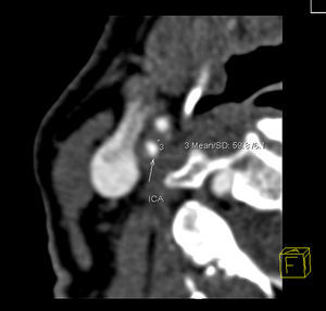 Tomografía computarizada multidetector. Placa con la menor densidad tisular medida de 59,8 UH. F: posición del paciente en relación con la imagen mostrada; ICA: arteria carótida interna.