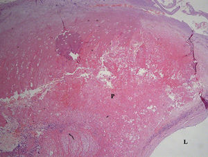 Hemorragia en la placa (placa de tipo VIb). La misma placa que en la figura 1. Tinción con hematoxilina y eosina, aumento original x 40. L: luz; P: placa.