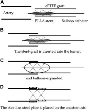 Representación esquemática de la anastomosis vascular sin sutura utilizando el stent de ácido poli L-láctico y la placa de acero inoxidable. Artery=Arteria. ePTFE graft=Implante de PTFEe. PLLA stent=Stent de PLLA. Ballon catheter=Catéter con balón. The stent-graft is inserted into the lumen, and ballon-expanded=Inserción del implante-stent en la luz y expansión mediante balón. The stainless steel plate is placed on the anastomosis=Colocación de la placa de acero inoxidable en la anastomosis
