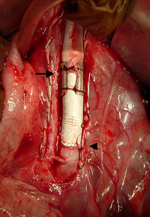 Vista tras completar las anastomosis. La anastomosis proximal se completa con el dispositivo anastomósico sin suturas (flecha), y la anastomosis distal está suturada (punta de flecha).
