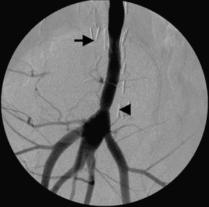 Angiograma de la aorta durante la cuarta semana tras la intervención. No existen signos de estenosis o de fuga en el lugar de la anastomosis sin suturas (flecha) o la anastomosis suturada (punta de flecha). El stent proporciona imagen negativa a los rayos X.