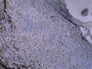 Tinción inmunohistoquímica: células NF-kappaB positivas del injerto venoso en el grupo de control 4 semanas después de la cirugía (SP x 400).
