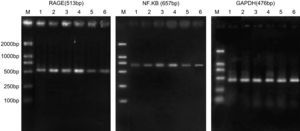 Resultados de la reacción en cadena de la polimerasa retrotranscriptasa (RCP-RT) de la expresión de ARNm de RAGE y p65 de NF-kappaB. RAGE (513bp), NF-kappaB (657bp), GAPDH (476bp). 1: ratas diabéticas que bebieron aminoguanidina (AG) una semana después de la cirugía; 2: ratas diabéticas que bebieron AG 4 semanas después de la cirugía; 3: ratas diabéticas que bebieron agua destilada una semana después de la cirugía; 5: ratas de control una semana después de la cirugía; 6: ratas de control 4 semanas después de la cirugía; M: marcador.