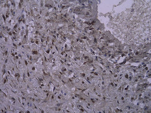 Tinción inmunohistoquímica: células PCNA-positivas del injerto venoso en el grupo que bebió agua destilada 4 semanas después de la cirugía (SP x 400).