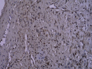 Tinción inmunohistoquímica: células PCNA positivas del injerto venoso en el grupo control después de la cirugía (SP x 400).