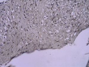 Tinción inmunohistoquímica: células RAGE positivas del injerto venoso en el grupo que bebió AG 4 semanas después de la cirugía (SP x 400).