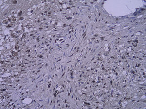 Tinción inmunohistoquímica: células RAGE positivas del injerto venoso en el grupo que bebió agua destilada 4 semanas después de la cirugía (SP x 400).