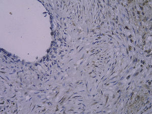 Tinción inmunohistoquímica: células RAGE-positivas del injerto venoso en el grupo de control 4 semanas después de la cirugía (SP x 400).
