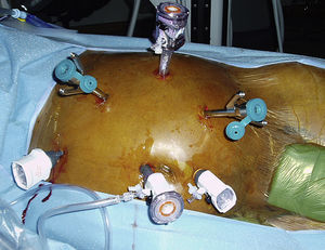 Colocación de los trócares. La triangulación de los tres puertos robóticos se localizó en la cara lateral y los tres puertos laparoscópicos en la cara medial del paciente.