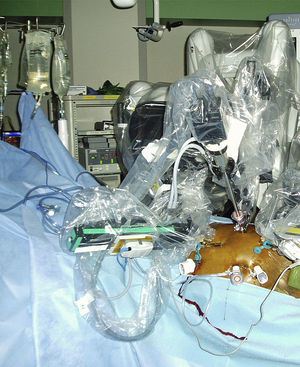 Acoplamiento de los brazos robóticos. El robot quirúrgico de tres brazos se acopló en los puertos robóticos.