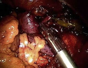 Visualización intraabdominal de la vena renal izquierda y de la vena gonadal. La vena gonadal se clampó con un aplicador de clip laparoscópico y fue sostenida por el anzuelo robótico.