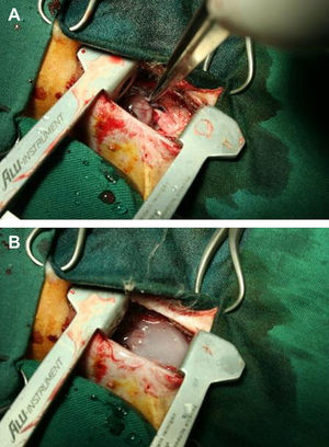 Aorta expuesta de conejo (A) y aorta cubierta con el gel de elastómero antes del cierre torácico (B).